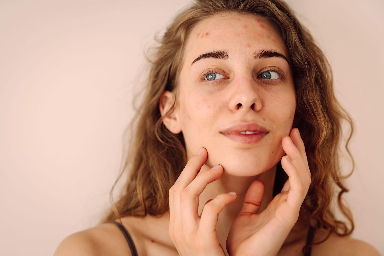 Boutons - microkystes - tendance acnéique - Oleassence en Luberon