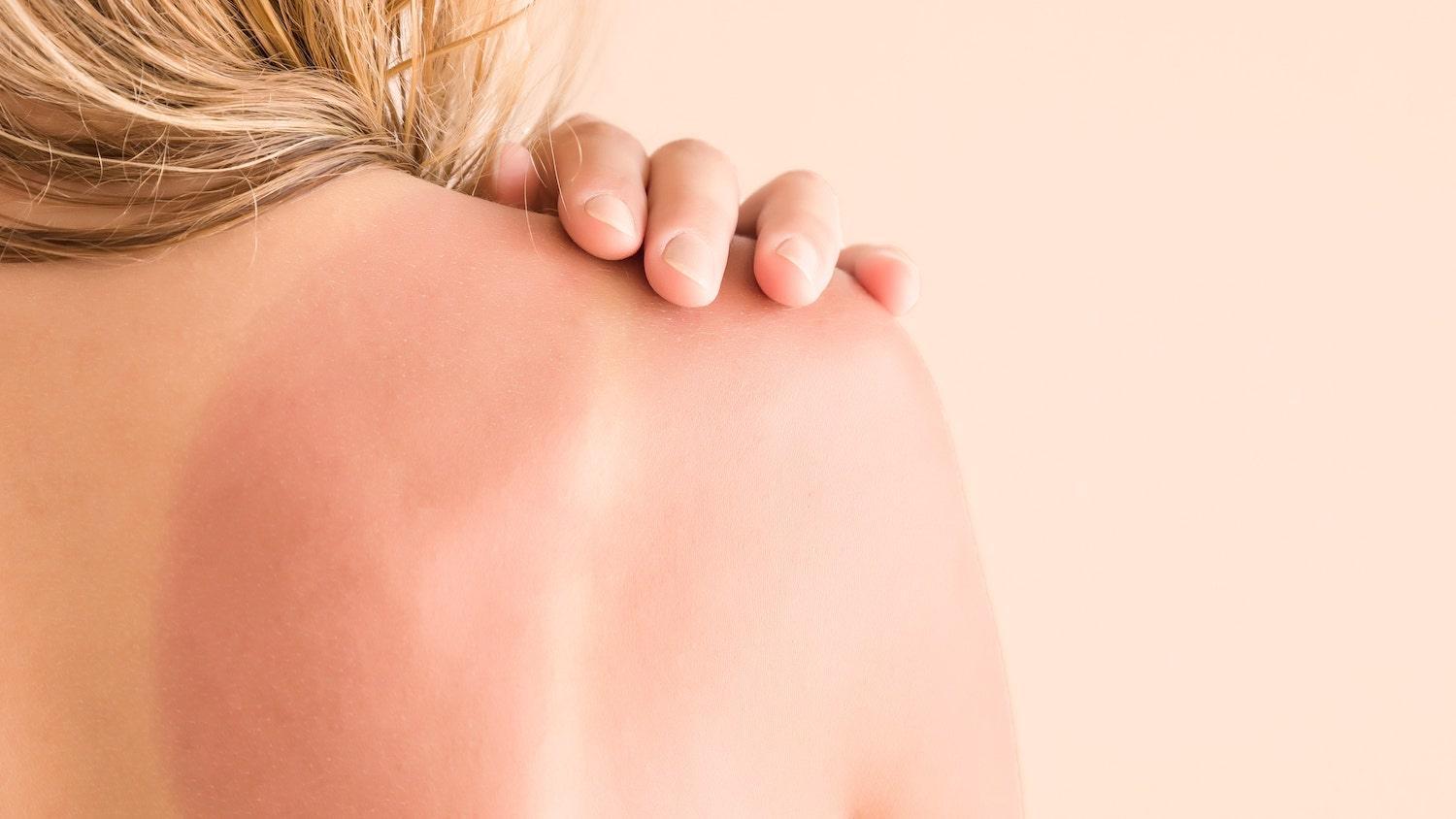 Peau échauffée, rougie - Oleassence en Luberon