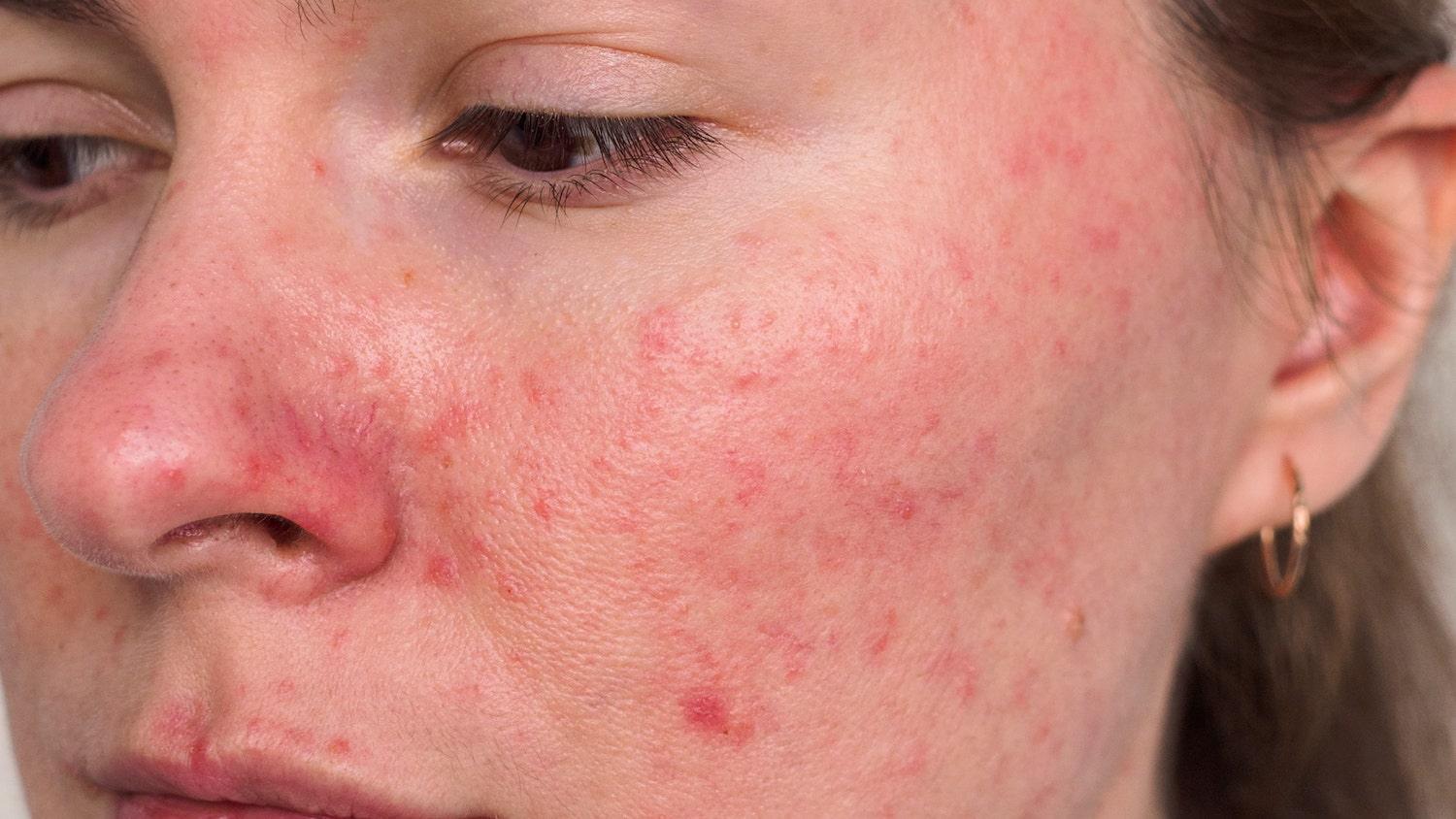 Peau sujette à l'acné rosacée - Oleassence en Luberon
