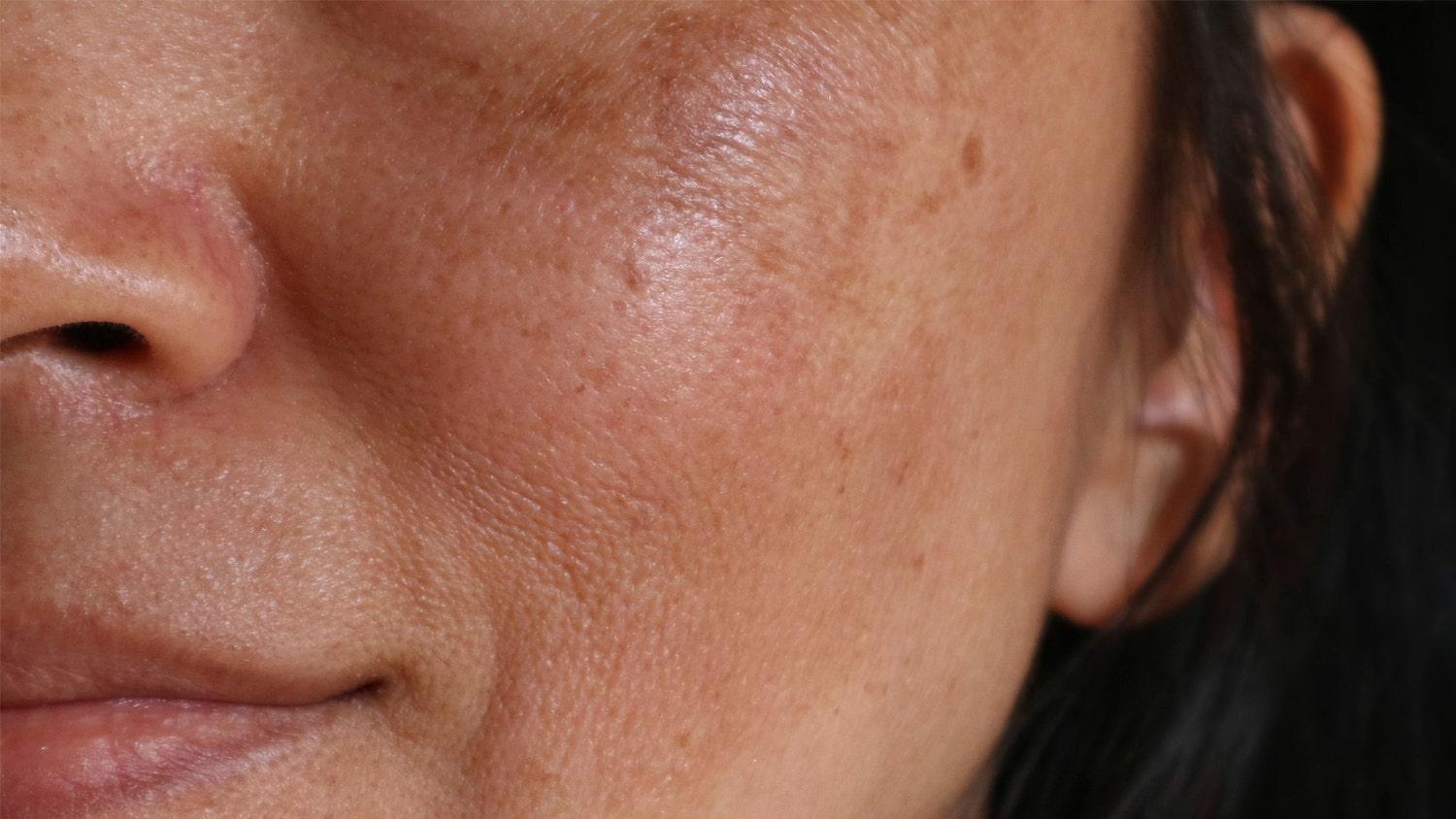 Taches Brunes - Oleassence en Luberon