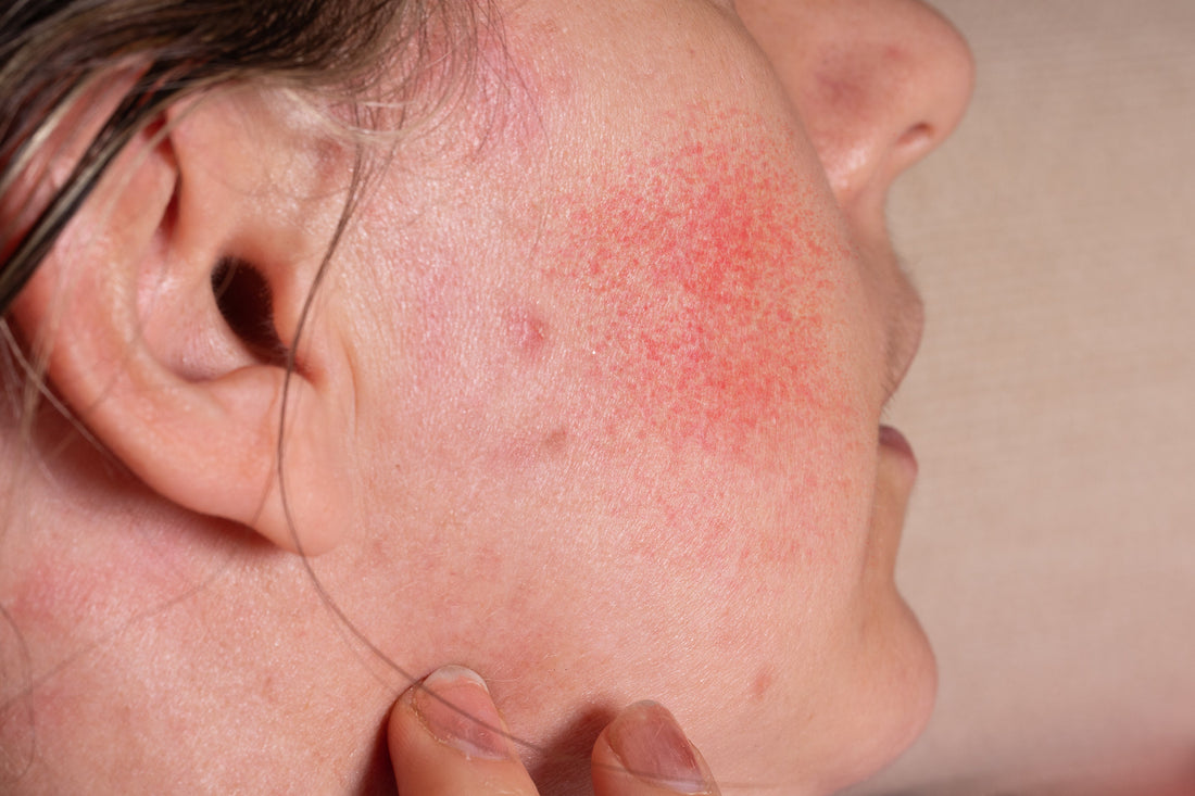 Rougeurs du visage : les comprendre et les apaiser naturellement selon leur origine