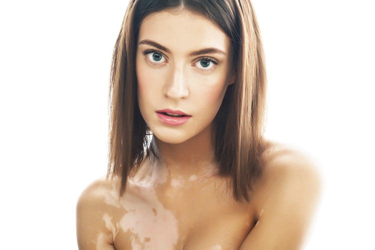 Tache Blanche, Dépigmentation de la peau : tout ce qu’il faut savoir - Oleassence en Luberon