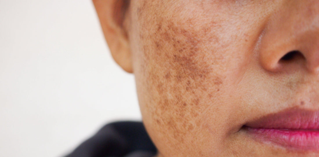 Taches brunes : comment les faire disparaitre naturellement ? - Oleassence en Luberon