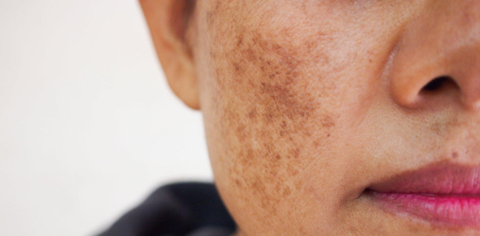 Taches brunes : comment les faire disparaitre naturellement ? - Oleassence en Luberon