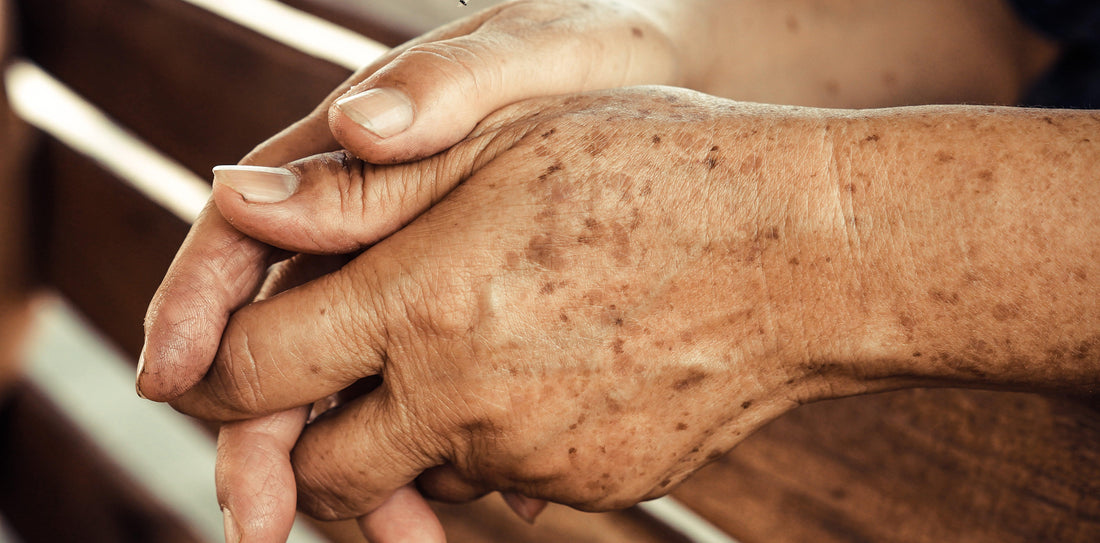 Un soin naturel puissant sur les taches brunes : OLEO-PREMIUM N°1 - Oleassence en Luberon