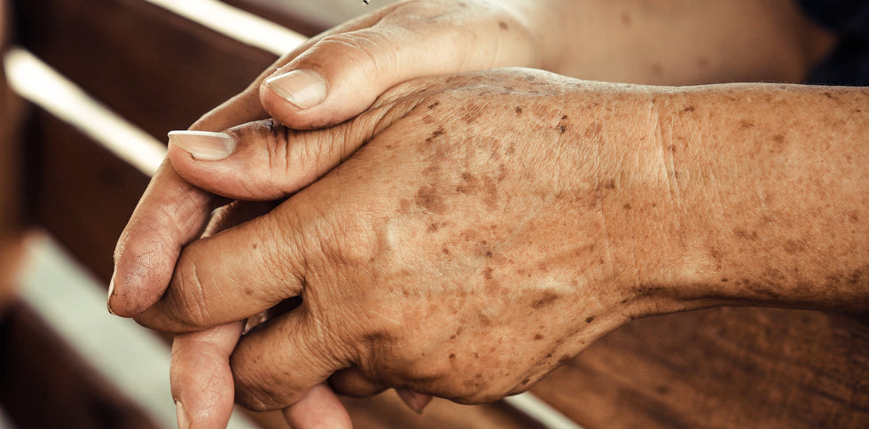 Un soin naturel puissant sur les taches brunes : OLEO-PREMIUM N°1 - Oleassence en Luberon