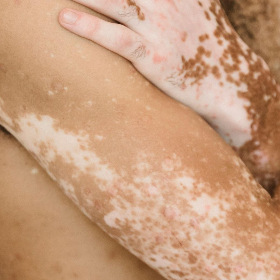 Vitiligo : mieux comprendre cette maladie dépigmentante de la peau